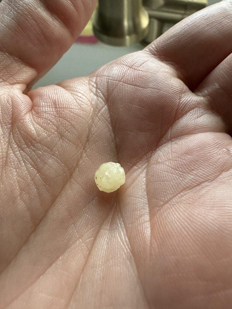 Bladder stone